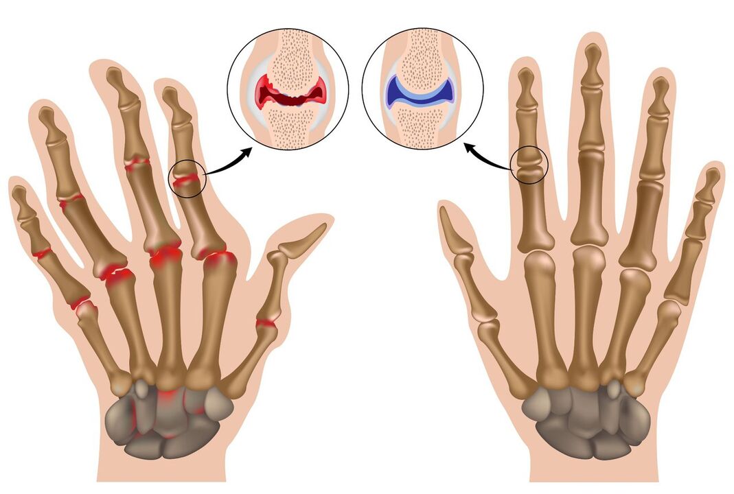 Joints of healthy hands and those with polyarthritis