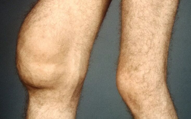 Post-traumatic osteoarthritis of the knee joint