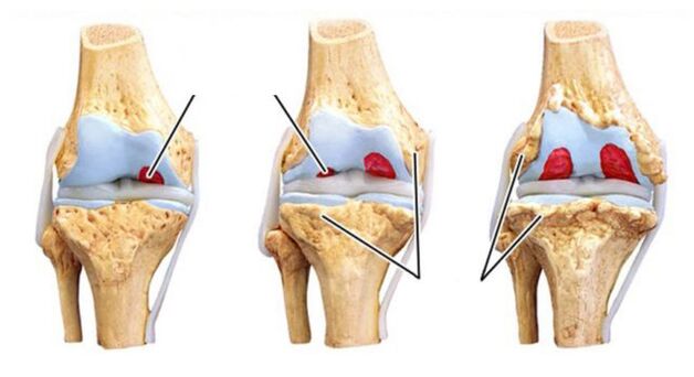 Complications of joint osteoarthritis