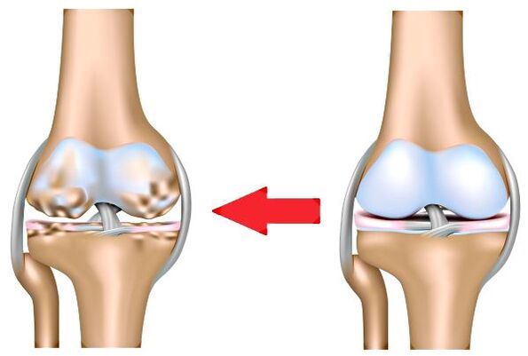 Healthy joint and osteoarthritis