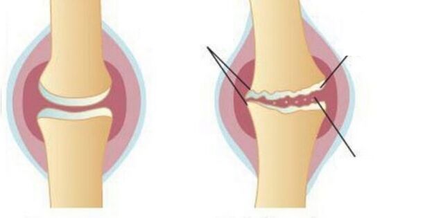 Wash cartilage