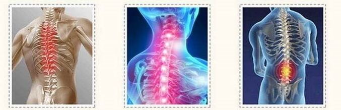 Osteochondrosis vertebral lesions
