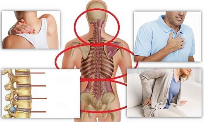 Places of illness for osteochondrosis