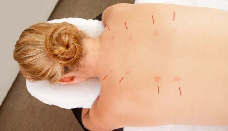 Acupuncture for thoracic osteochondrosis, which has many benefits